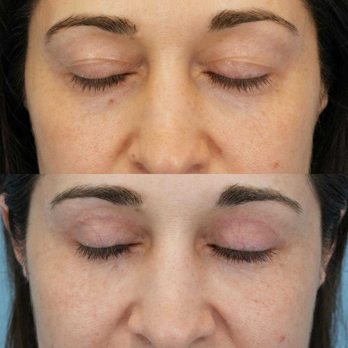 Blepharoplasty Before & After Gallery - Patient 272705 - Image 3