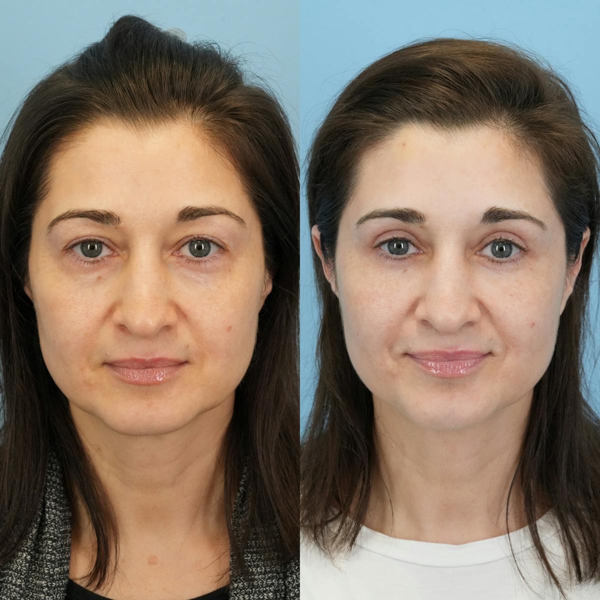 Blepharoplasty Before & After Gallery - Patient 272705 - Image 6