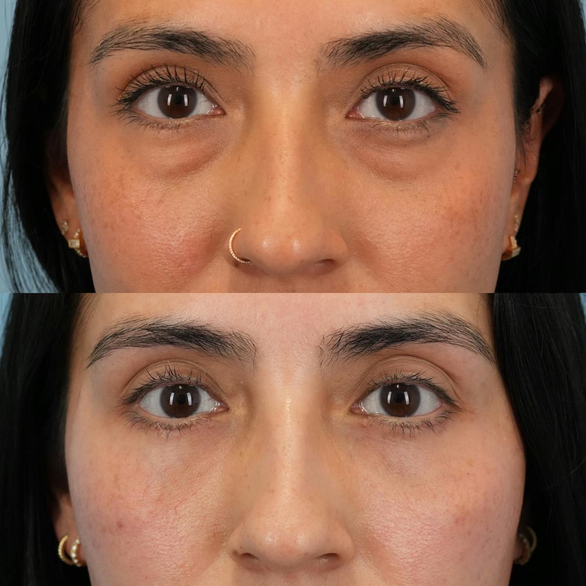 Blepharoplasty Before & After Gallery - Patient 343377 - Image 1