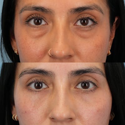 Blepharoplasty Before & After Gallery - Patient 799511 - Image 1