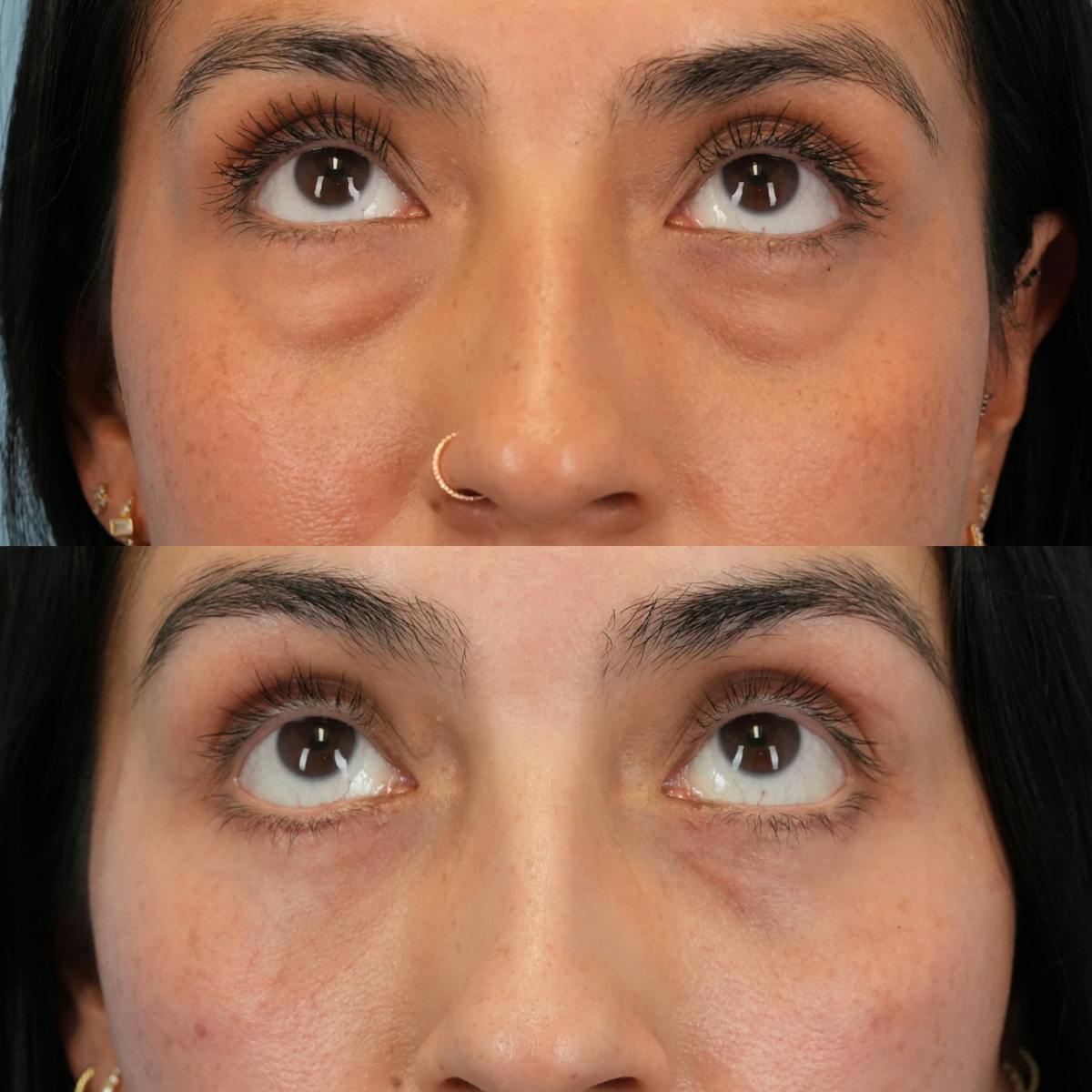 Blepharoplasty Before & After Gallery - Patient 343377 - Image 2