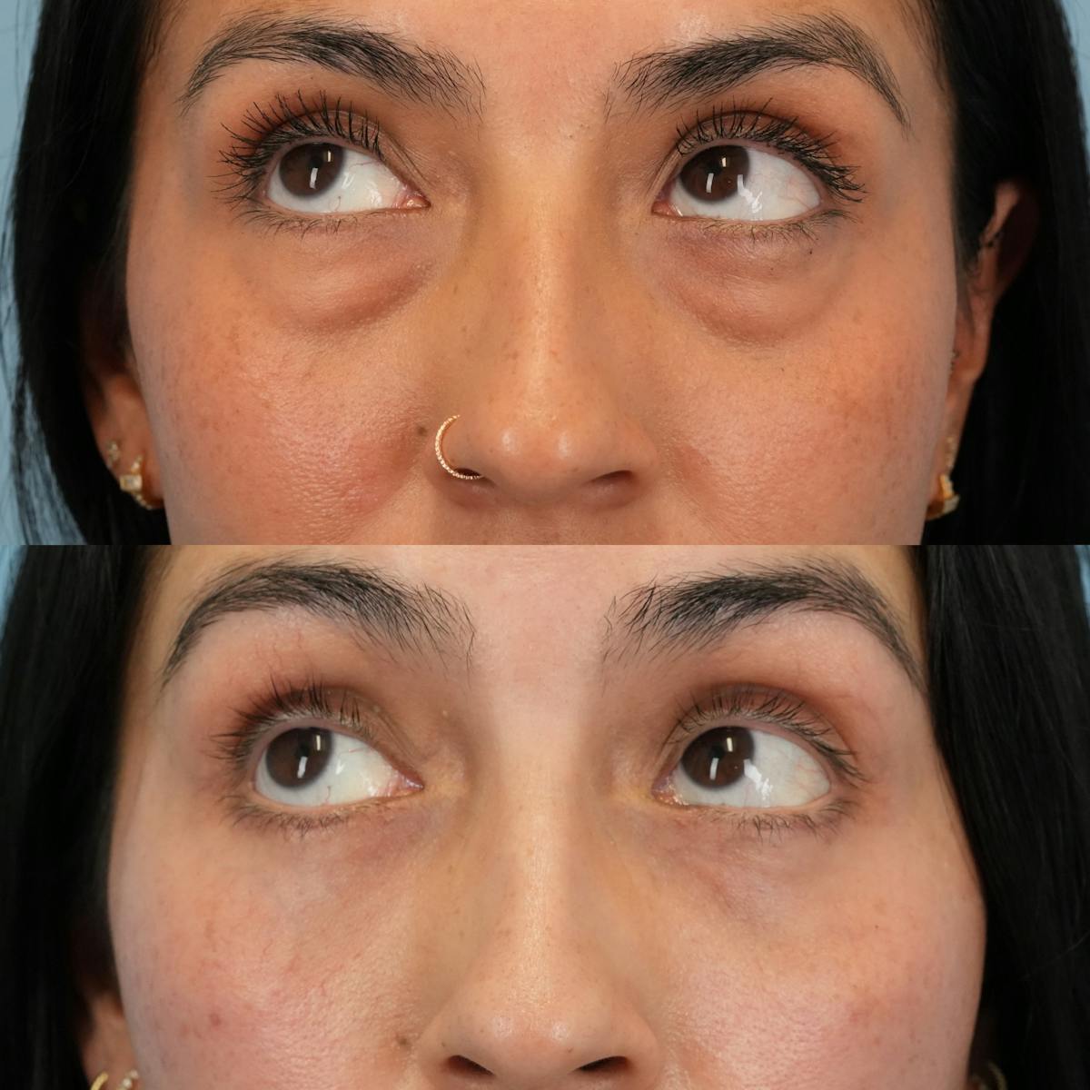 Blepharoplasty Before & After Gallery - Patient 343377 - Image 4
