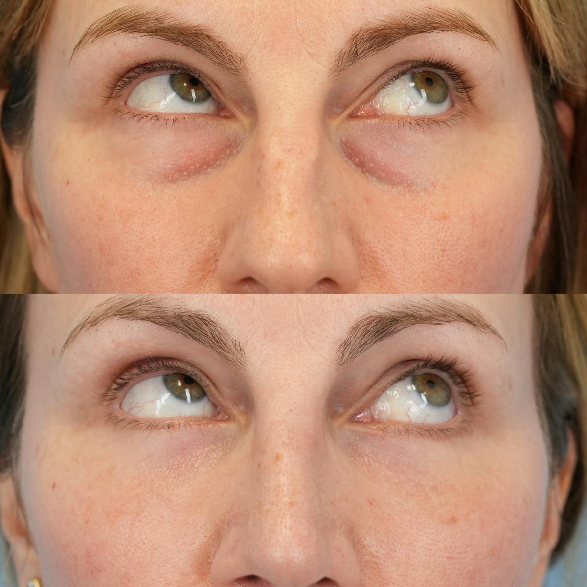 Blepharoplasty Before & After Gallery - Patient 138122 - Image 3