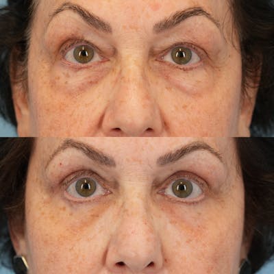 Blepharoplasty Before & After Gallery - Patient 111219 - Image 1