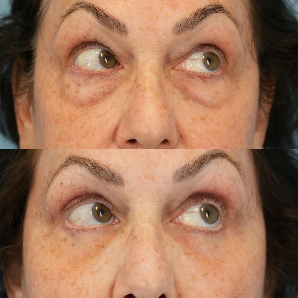 Blepharoplasty Before & After Gallery - Patient 111219 - Image 3