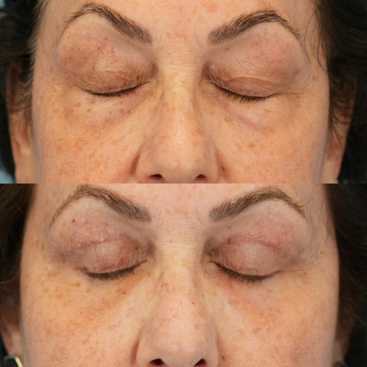 Blepharoplasty Before & After Gallery - Patient 111219 - Image 5