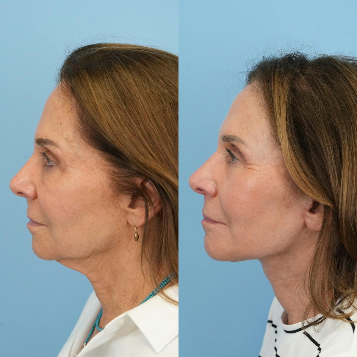 Blepharoplasty Before & After Gallery - Patient 174265 - Image 9