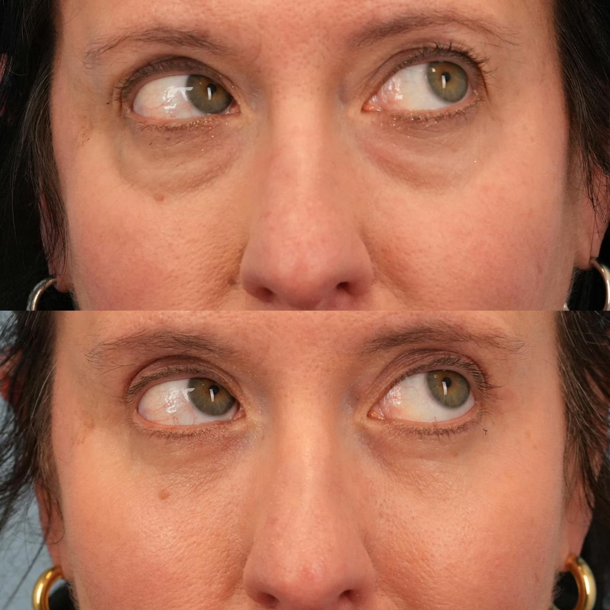 Blepharoplasty Before & After Gallery - Patient 186000 - Image 4