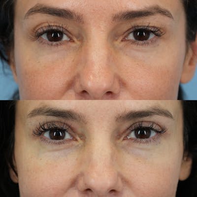 Upper Eyelids Before & After Gallery - Patient 344206 - Image 1