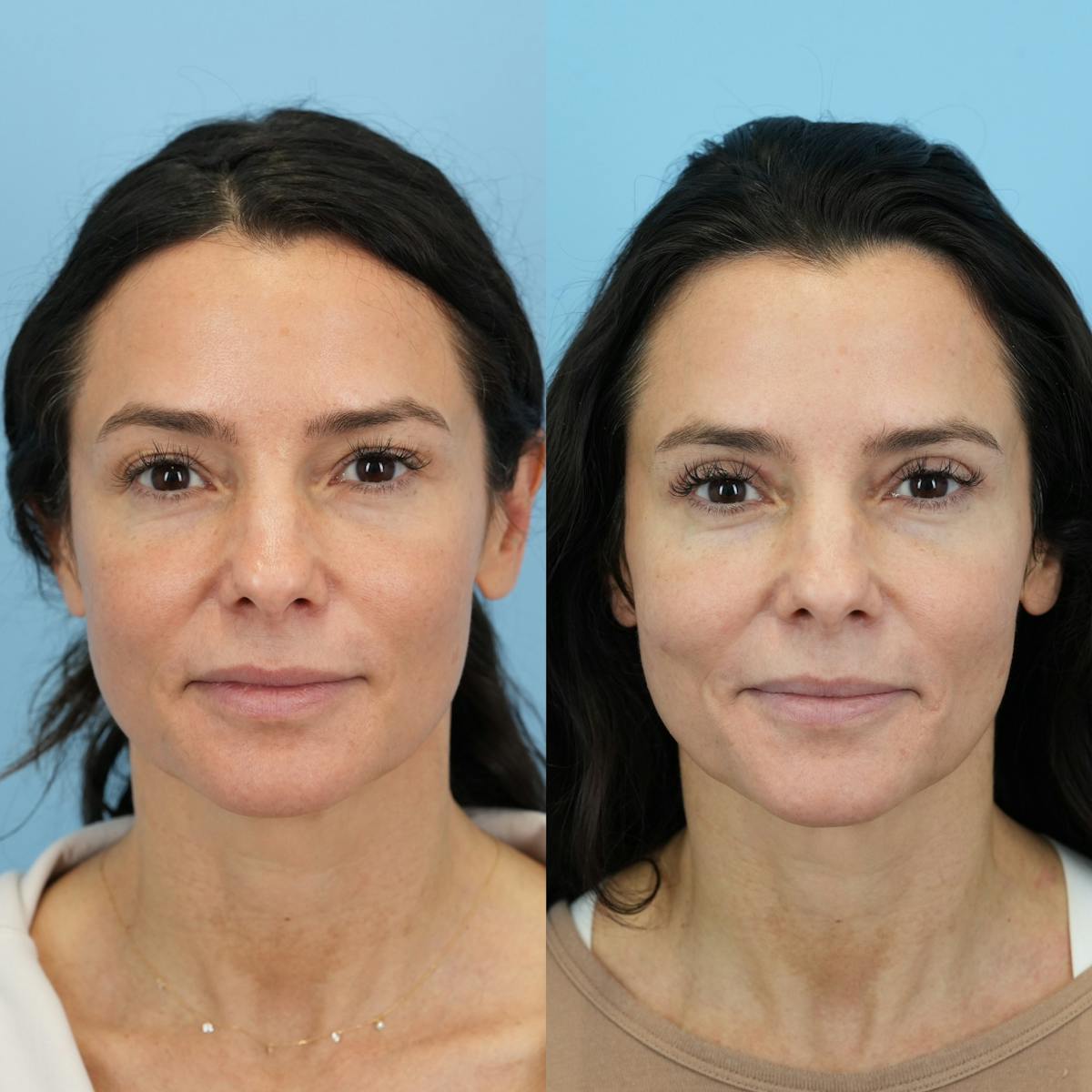 Upper Eyelids Before & After Gallery - Patient 344206 - Image 2