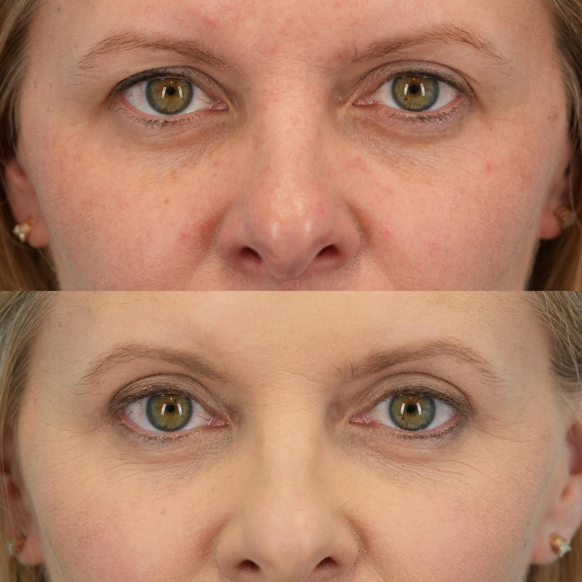 Upper Eyelids Before & After Gallery - Patient 166171 - Image 1