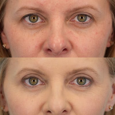 Upper Eyelids Before & After Gallery - Patient 166171 - Image 1