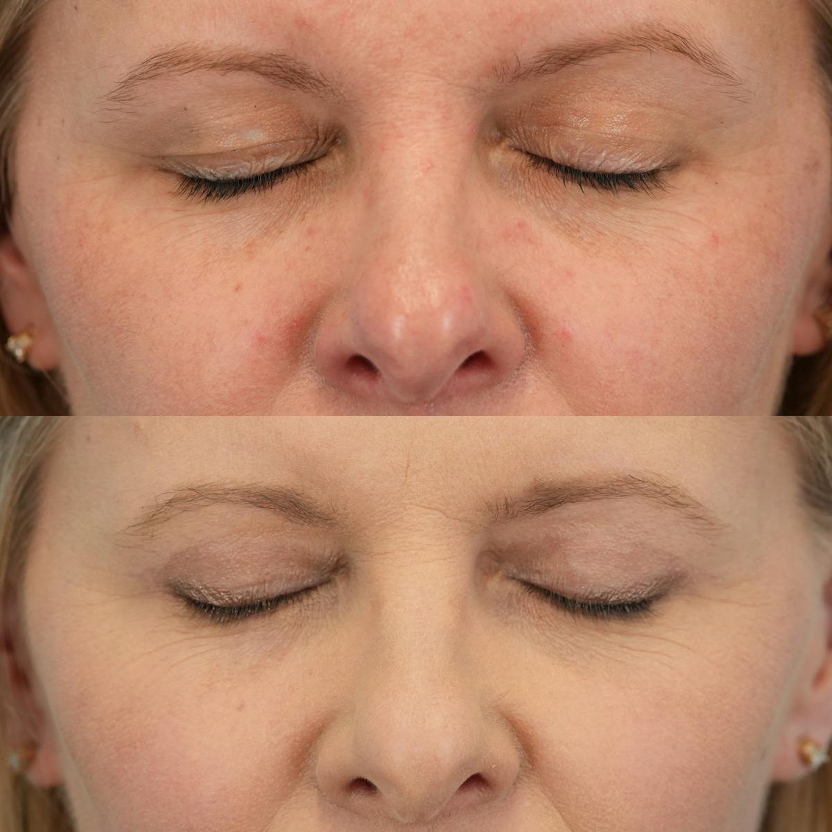Upper Eyelids Before & After Gallery - Patient 166171 - Image 2