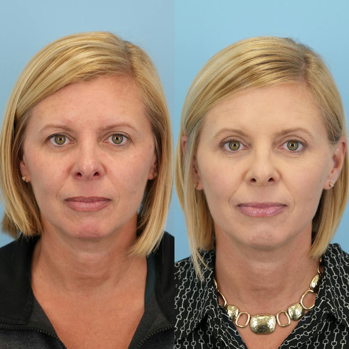 Upper Eyelids Before & After Gallery - Patient 166171 - Image 3