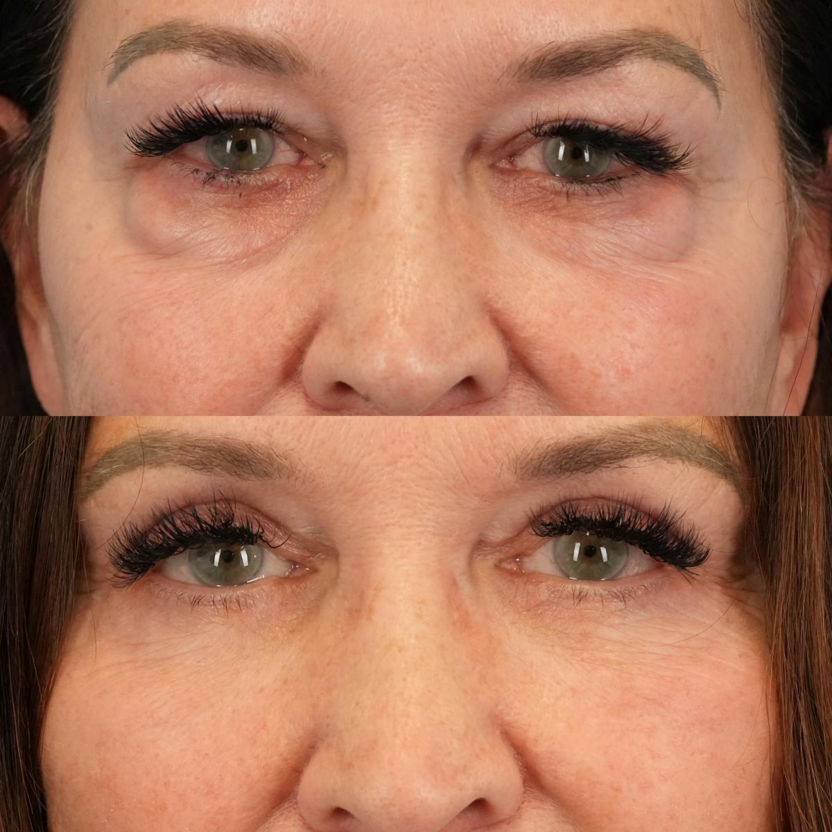 Lower Eyelids Before & After Gallery - Patient 130677 - Image 1