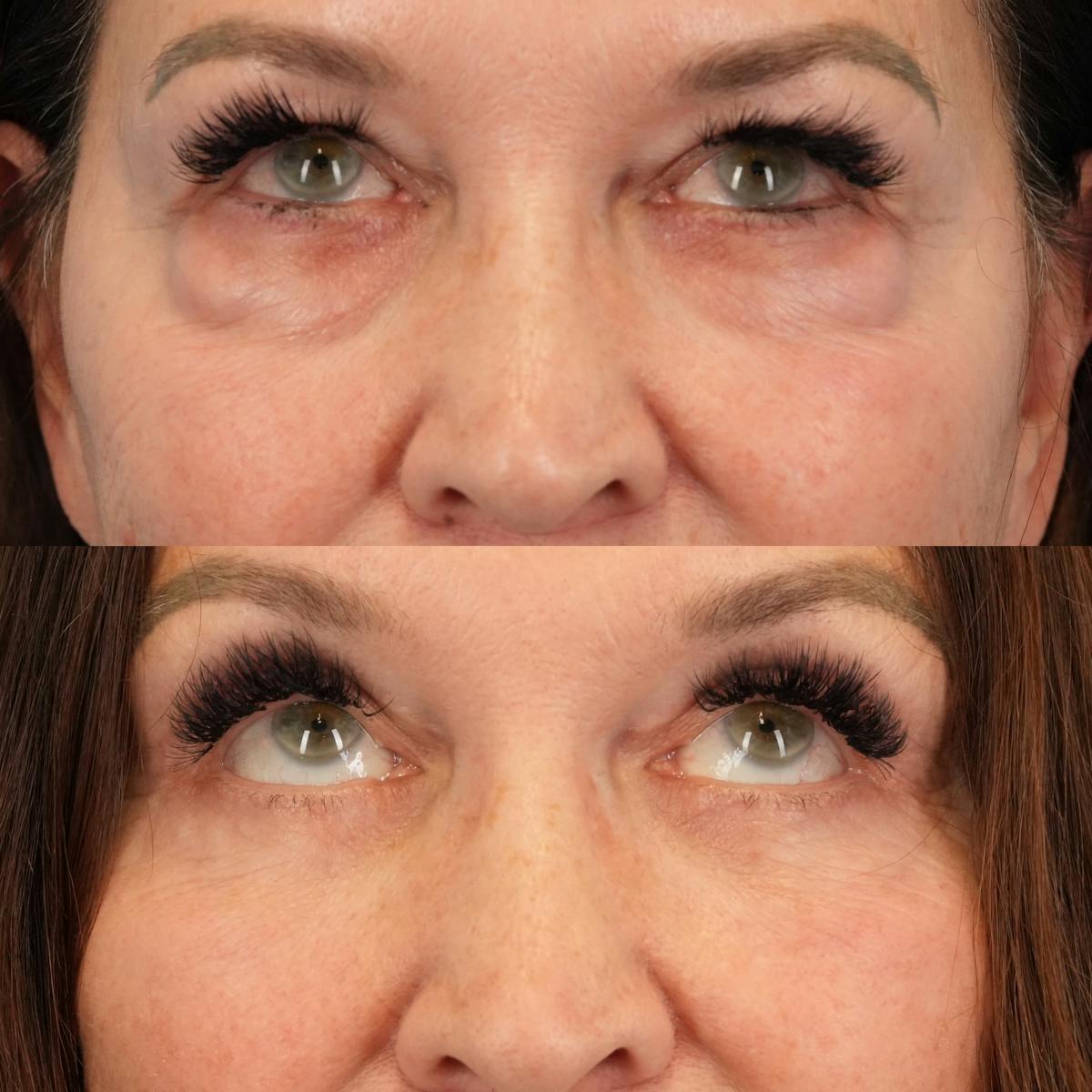 Lower Eyelids Before & After Gallery - Patient 130677 - Image 2