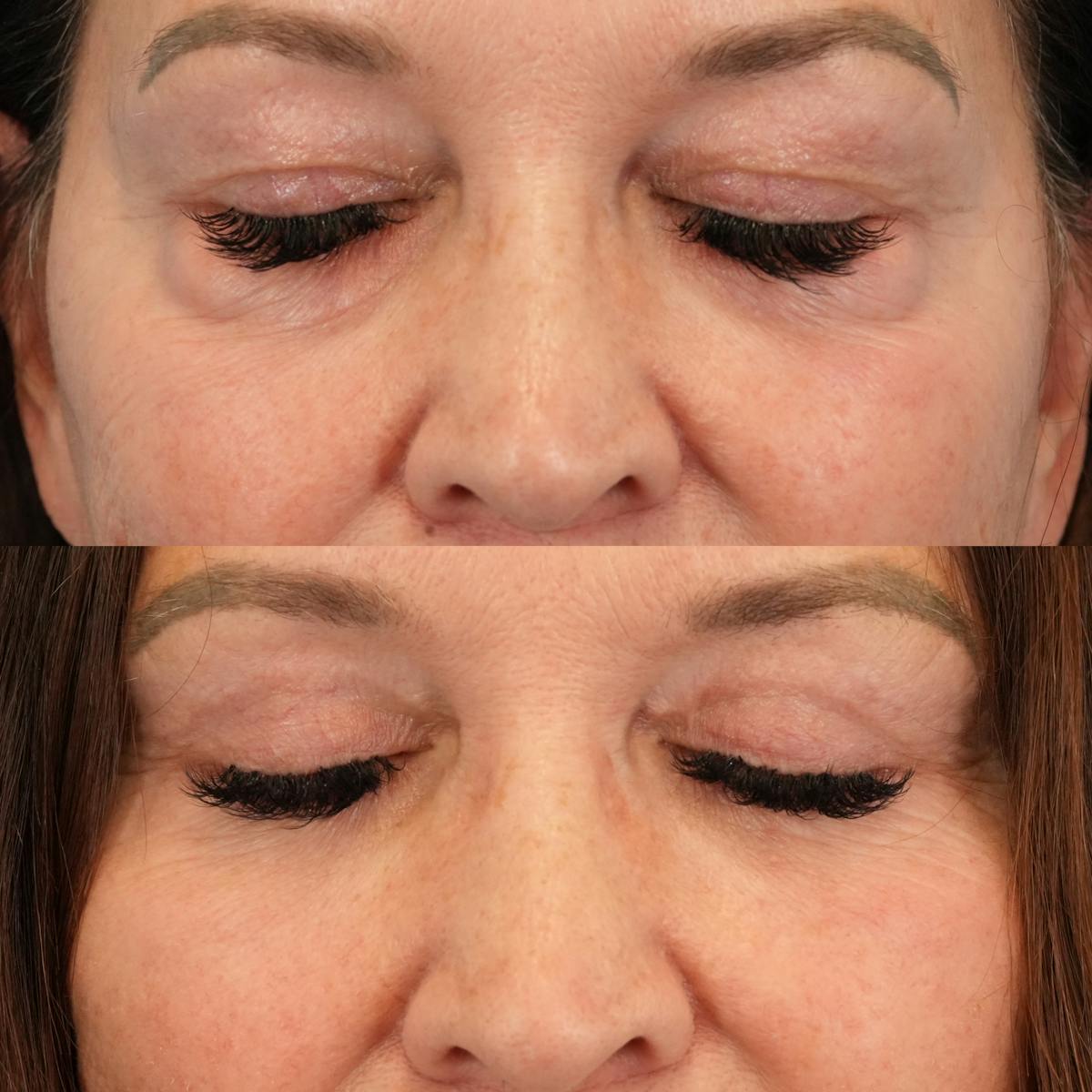Lower Eyelids Before & After Gallery - Patient 130677 - Image 3
