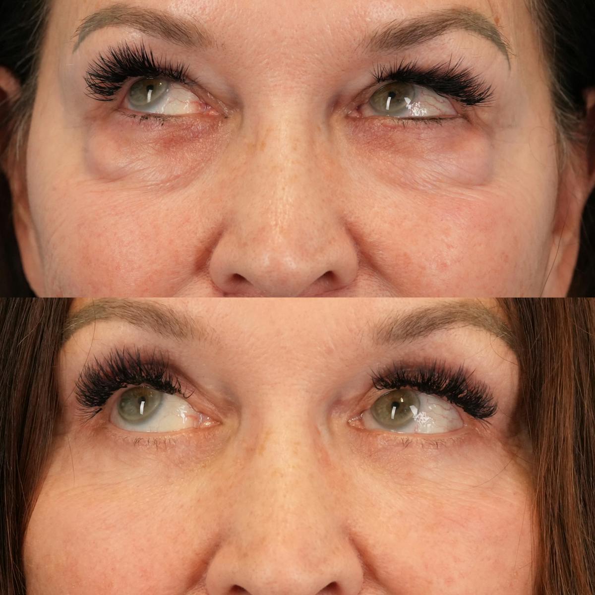 Lower Eyelids Before & After Gallery - Patient 130677 - Image 5