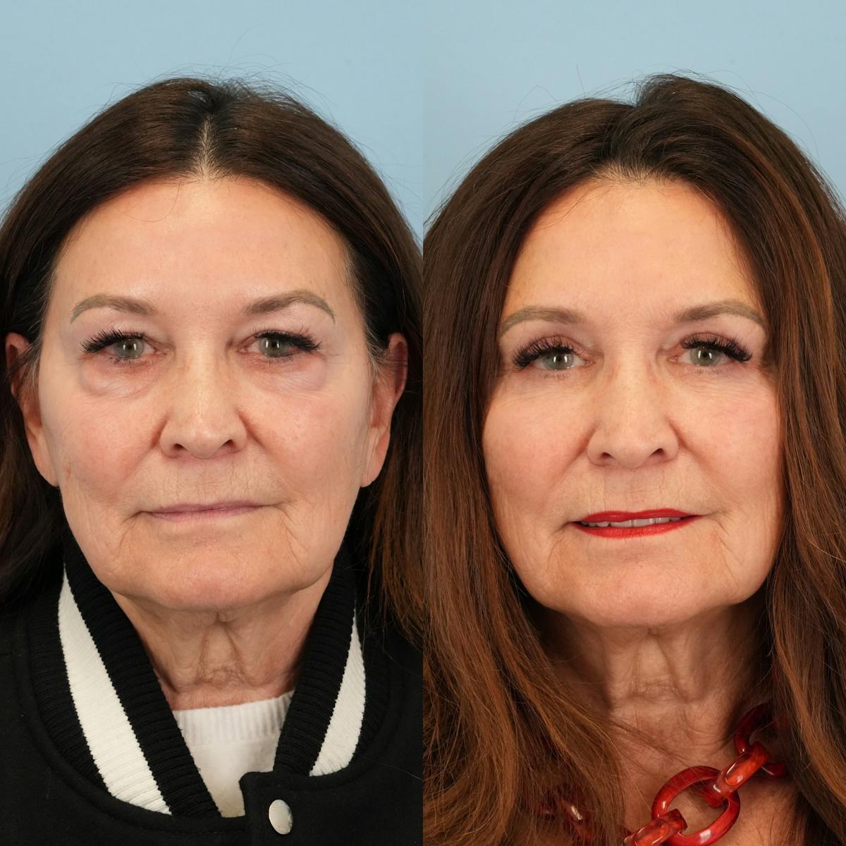 Lower Eyelids Before & After Gallery - Patient 130677 - Image 6