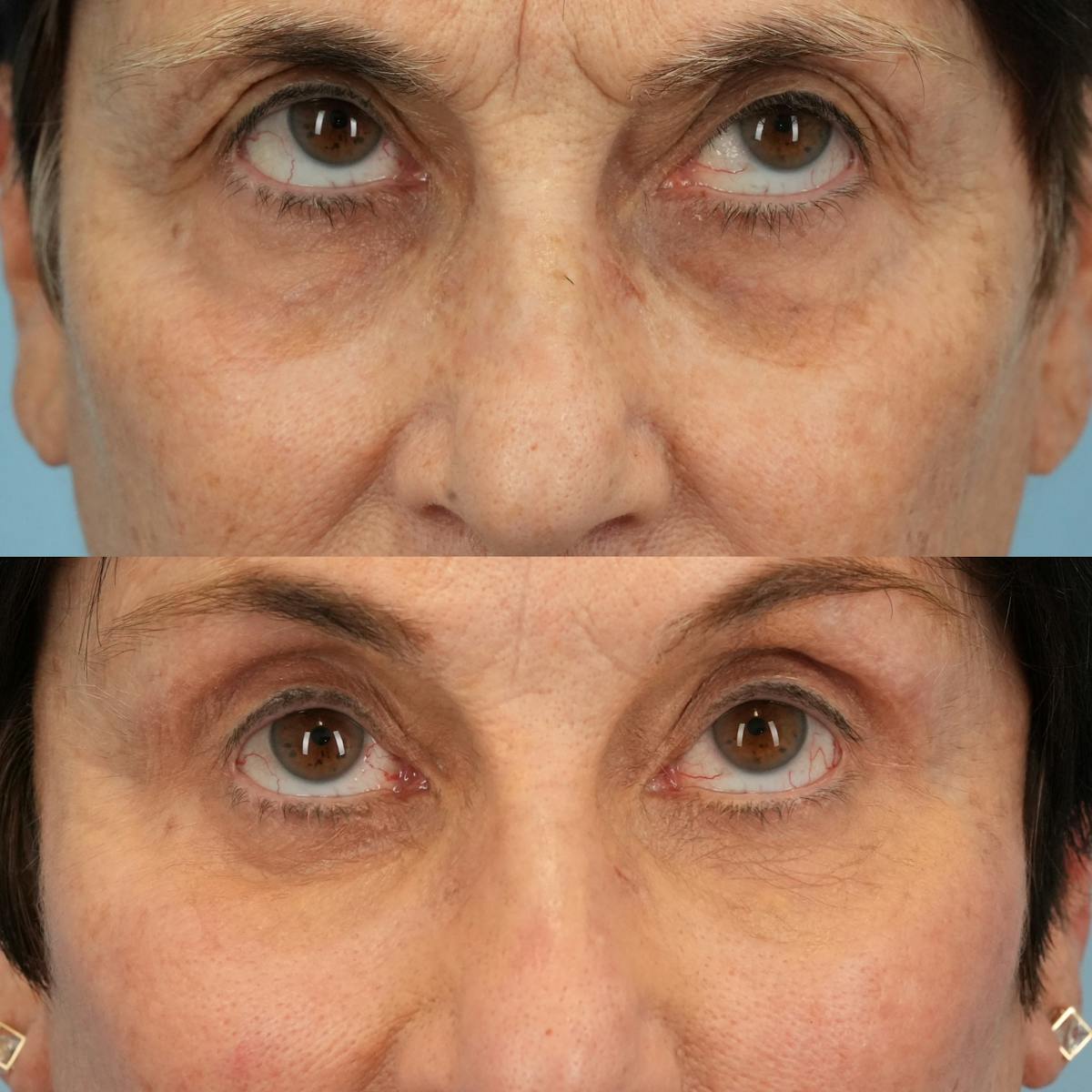 Lower Eyelids Before & After Gallery - Patient 171896 - Image 2