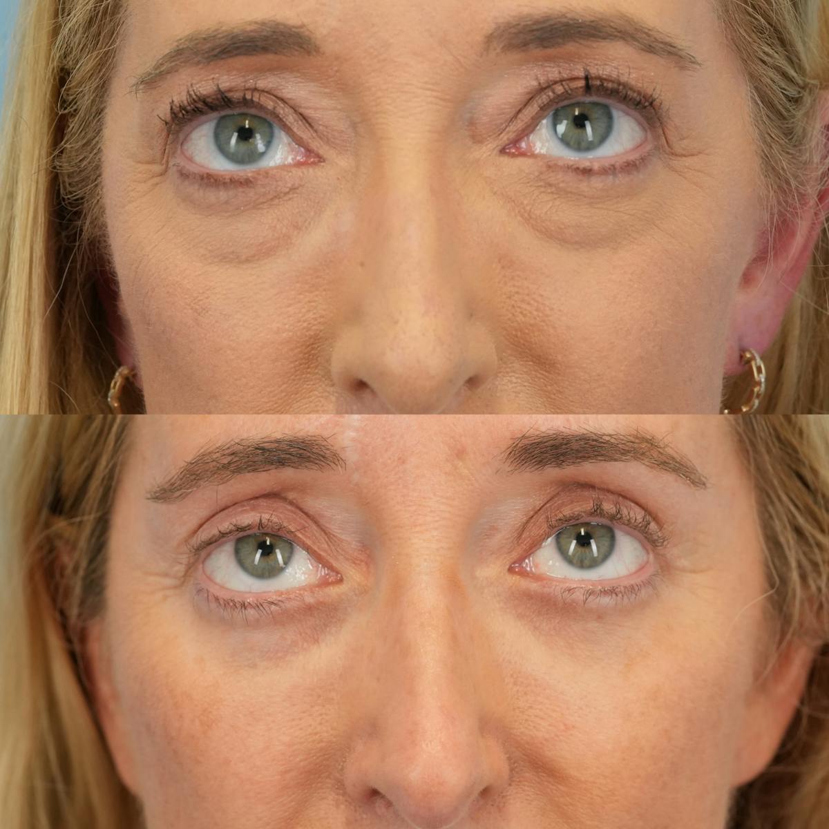 Upper Eyelids Before & After Gallery - Patient 252764 - Image 2