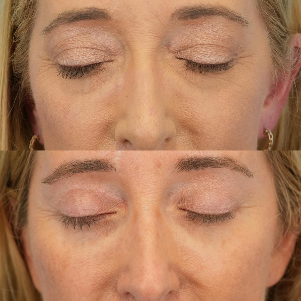 Upper Eyelids Before & After Gallery - Patient 252764 - Image 3