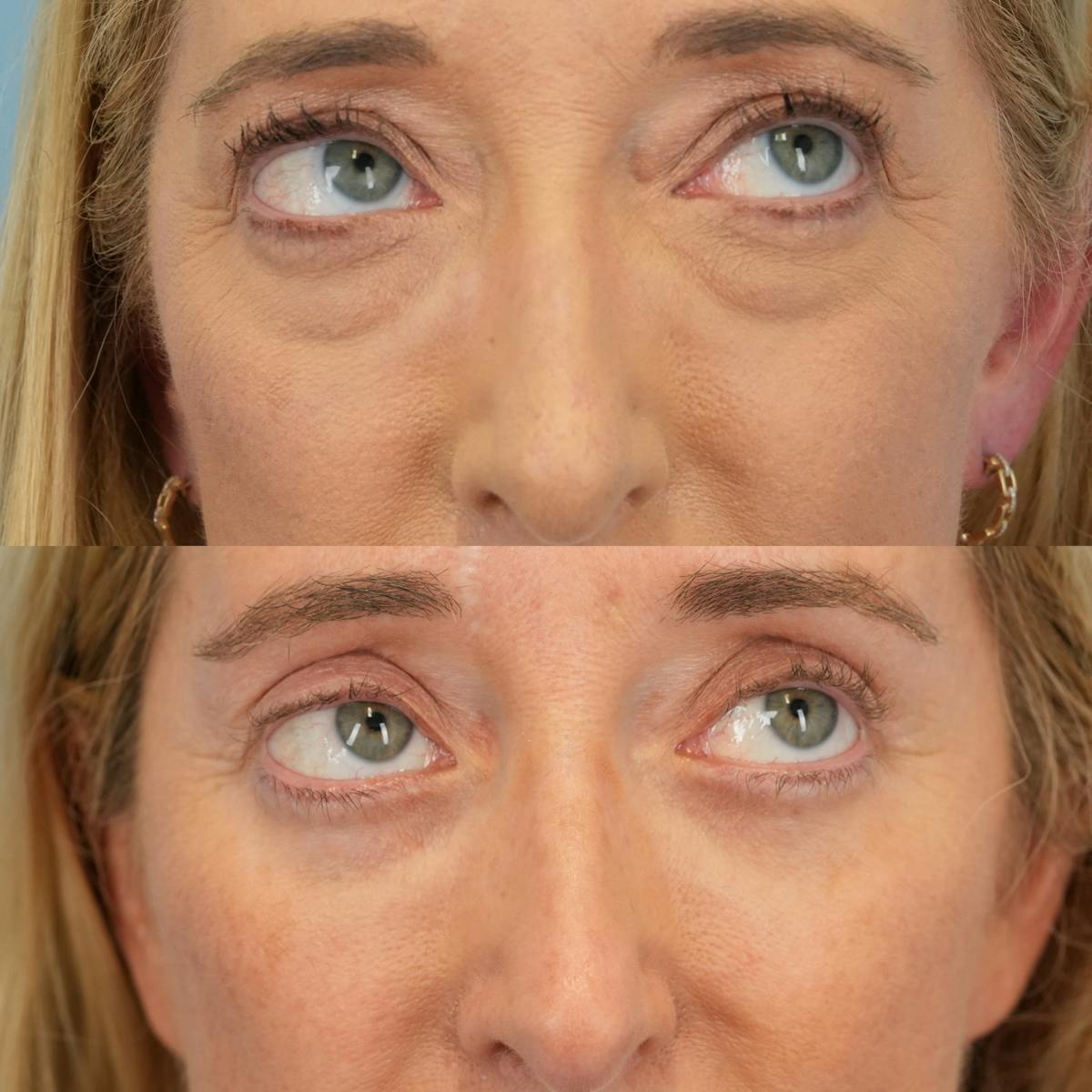 Upper Eyelids Before & After Gallery - Patient 252764 - Image 4
