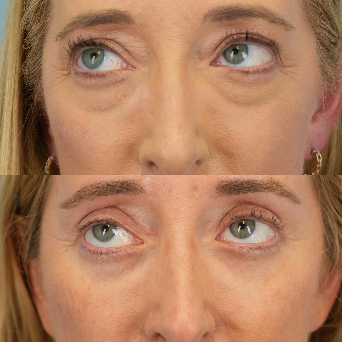 Upper Eyelids Before & After Gallery - Patient 252764 - Image 5