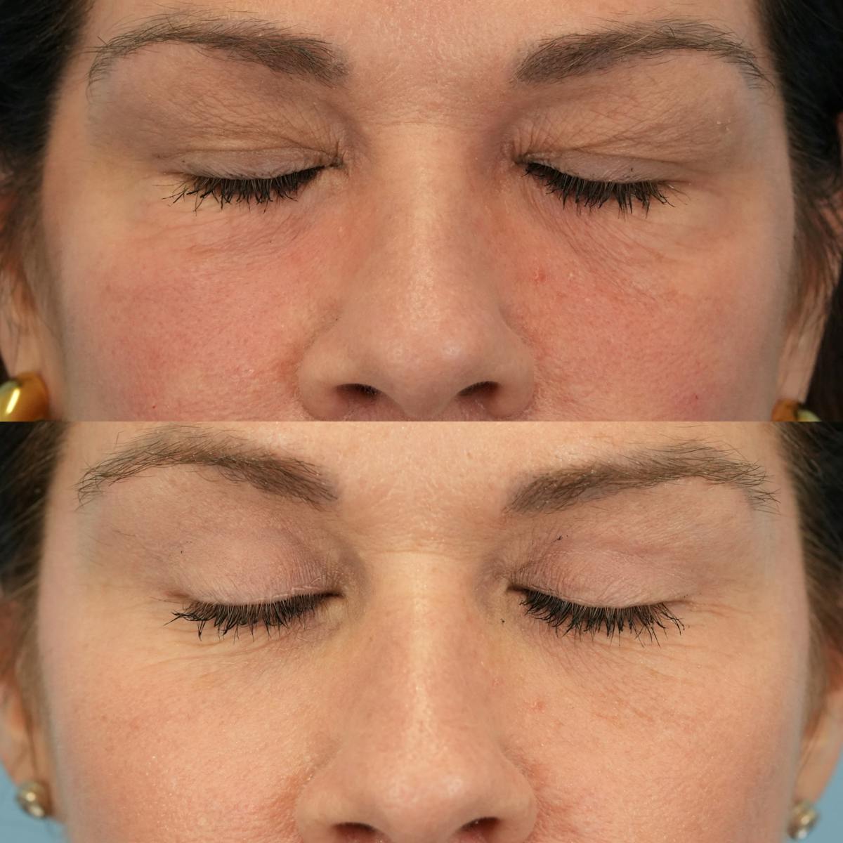 Lower Eyelids Before & After Gallery - Patient 268982 - Image 3