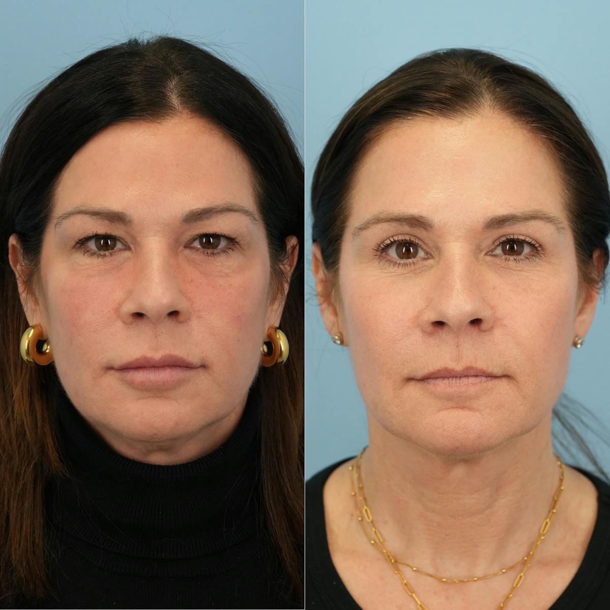 Lower Eyelids Before & After Gallery - Patient 268982 - Image 6