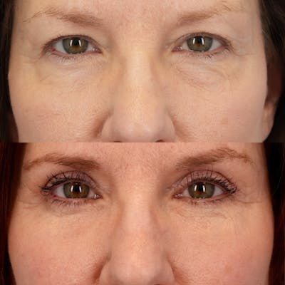 Lower Eyelids Before & After Gallery - Patient 705175 - Image 1