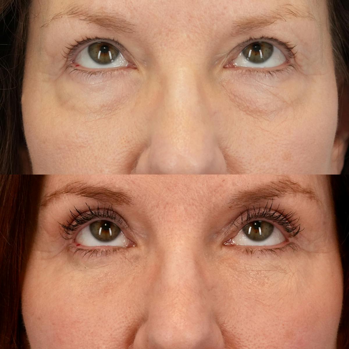 Lower Eyelids Before & After Gallery - Patient 705175 - Image 2
