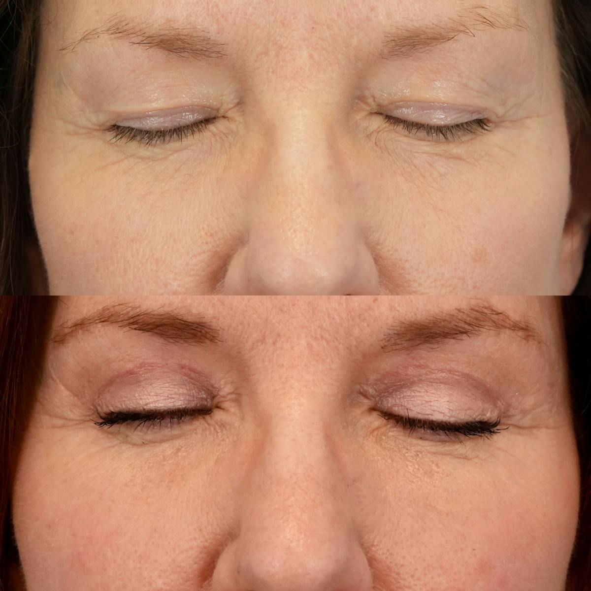 Lower Eyelids Before & After Gallery - Patient 705175 - Image 3