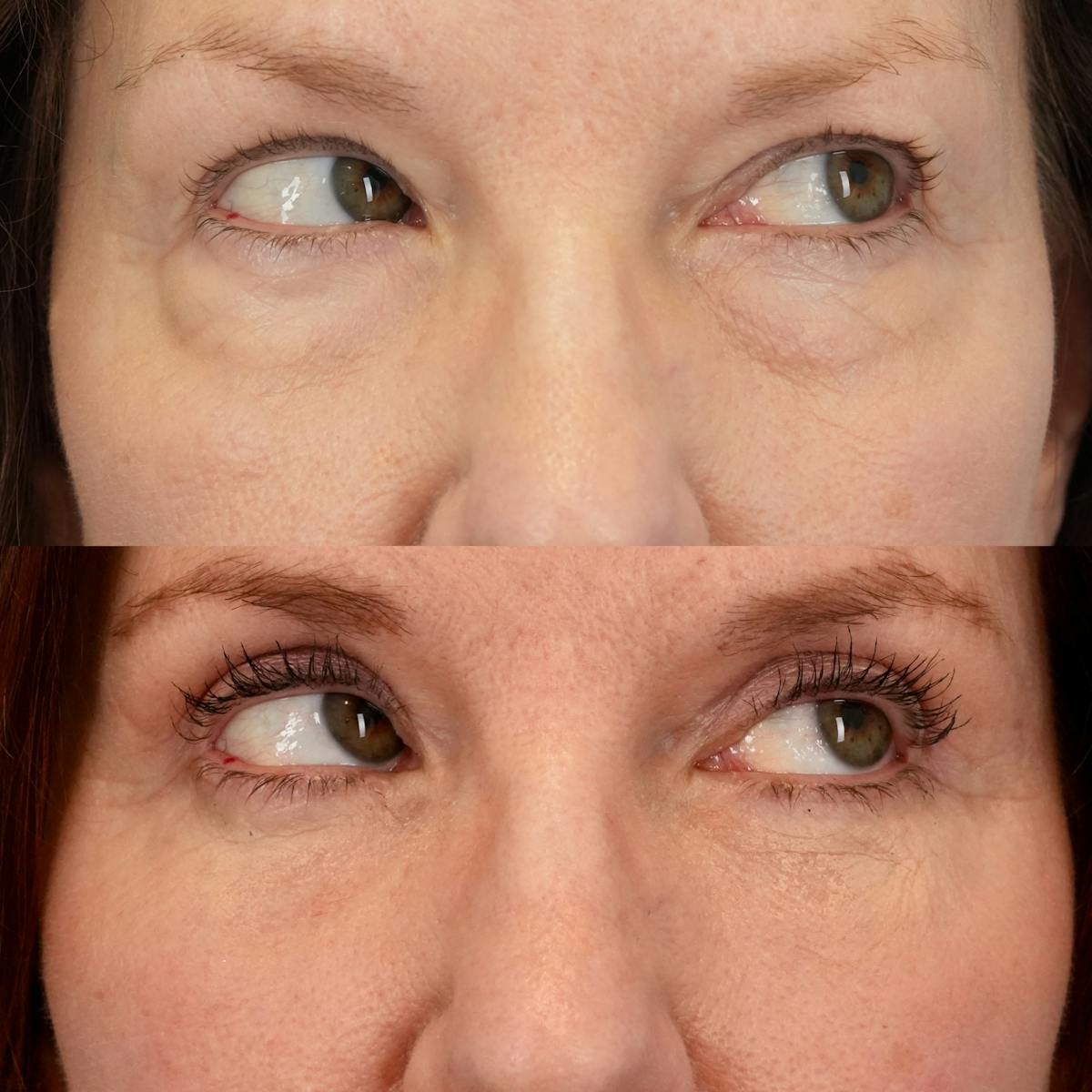 Lower Eyelids Before & After Gallery - Patient 705175 - Image 4