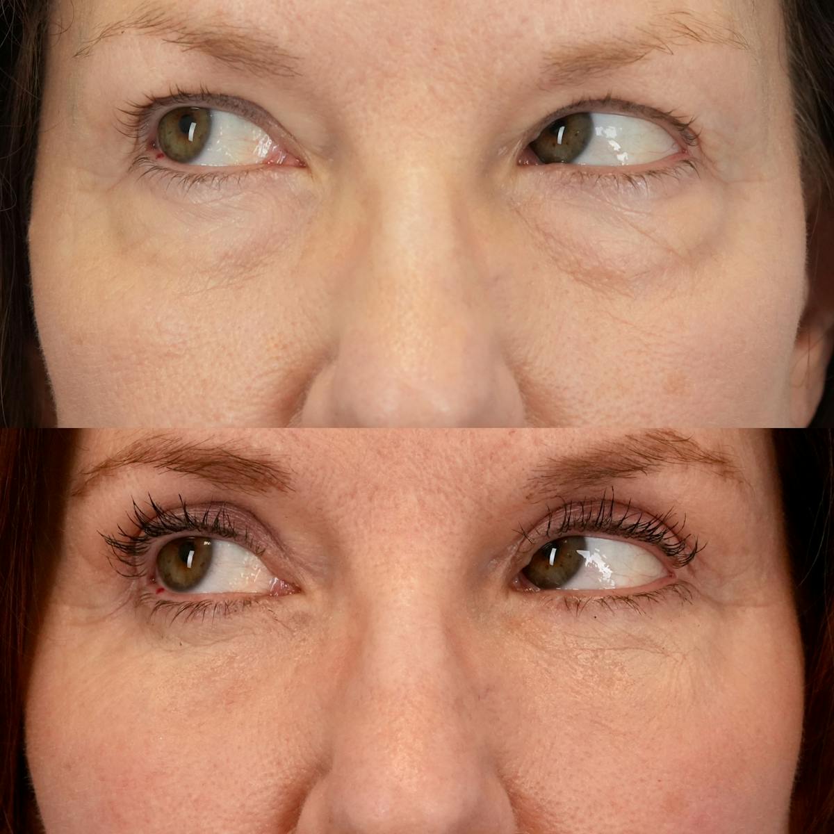 Lower Eyelids Before & After Gallery - Patient 705175 - Image 5