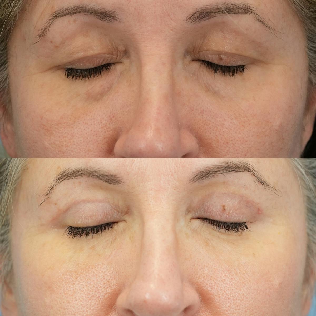 Lower Eyelids Before & After Gallery - Patient 988997 - Image 3