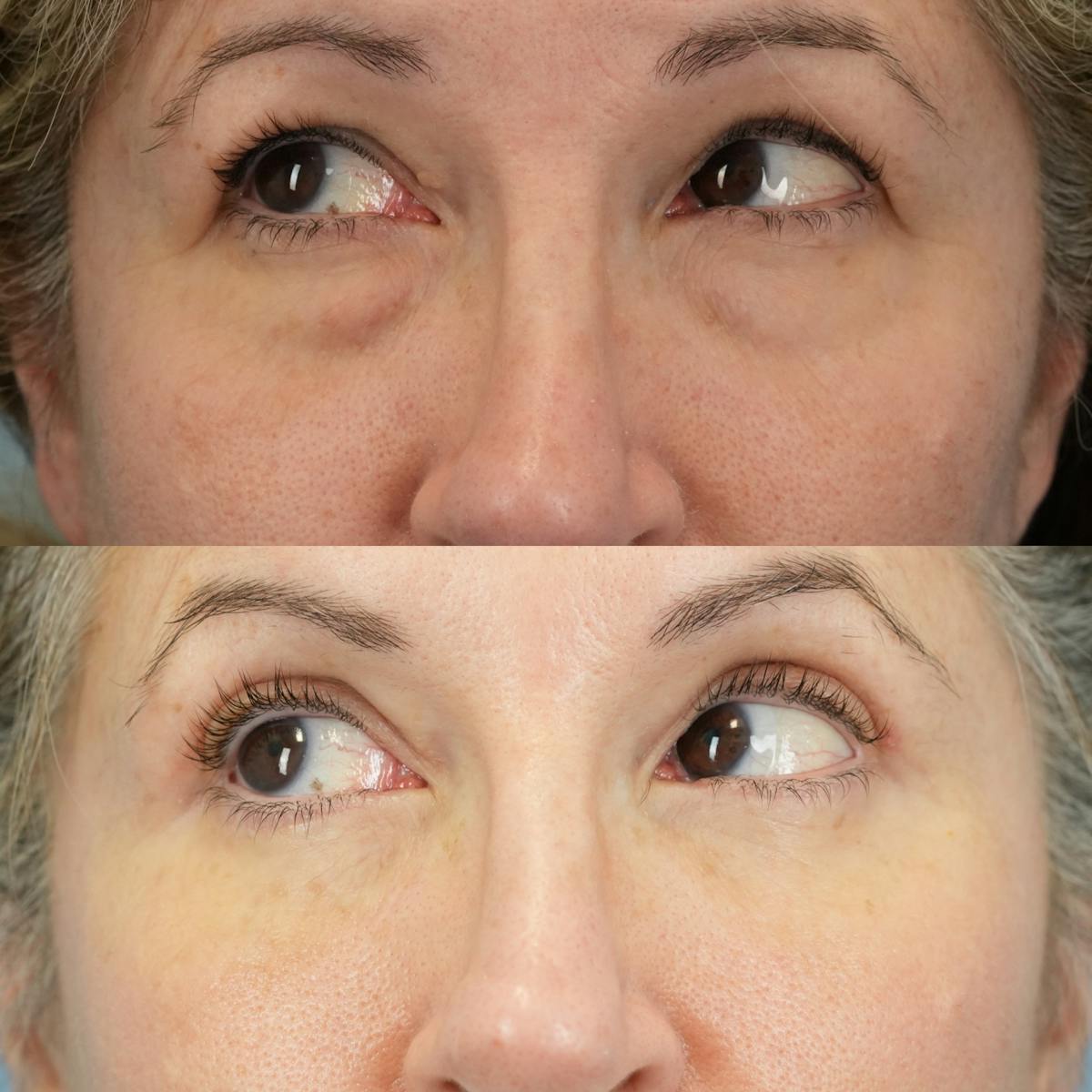 Lower Eyelids Before & After Gallery - Patient 988997 - Image 5