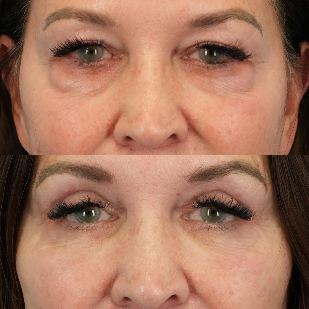 Upper Eyelids Before & After Gallery - Patient 136799 - Image 1