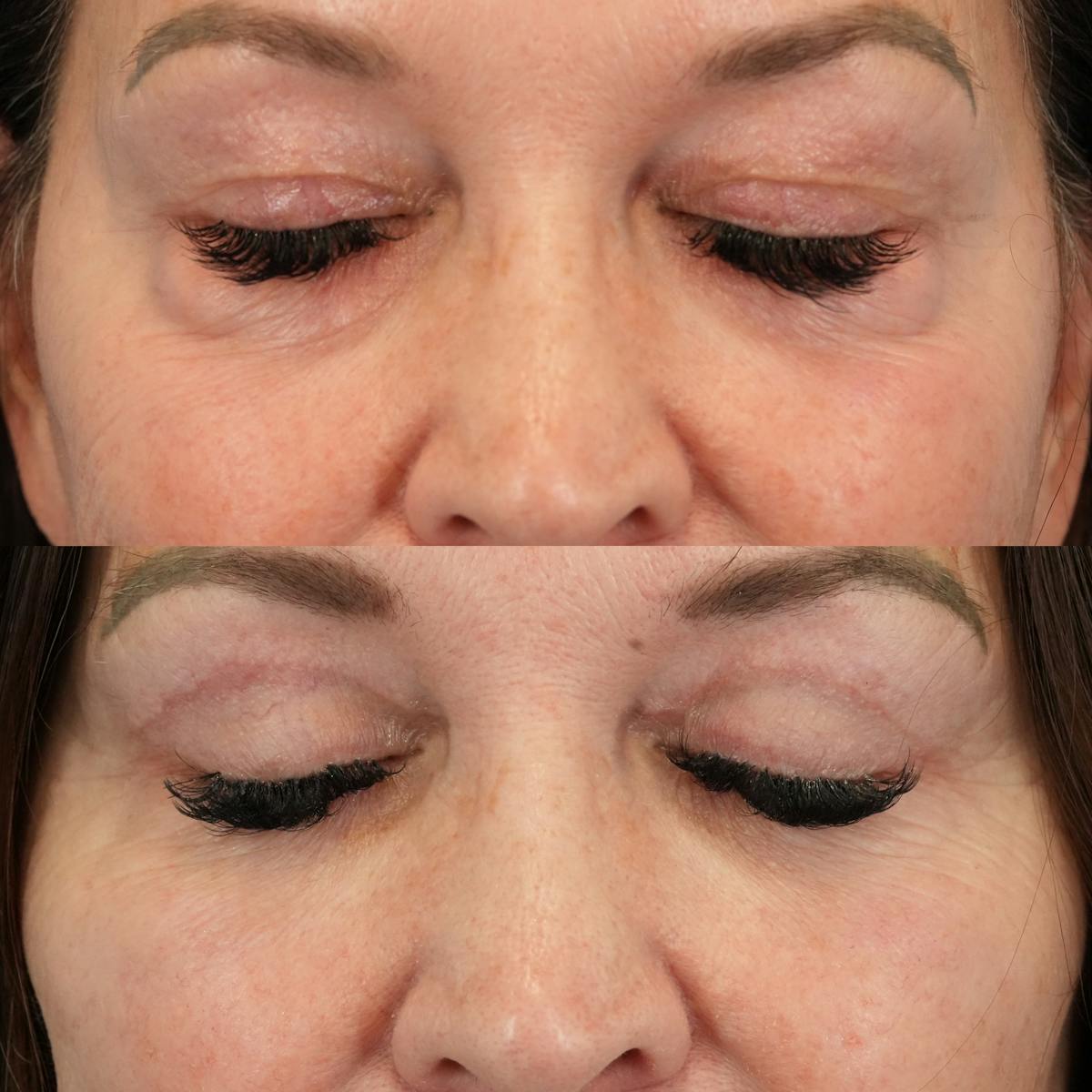 Upper Eyelids Before & After Gallery - Patient 136799 - Image 3