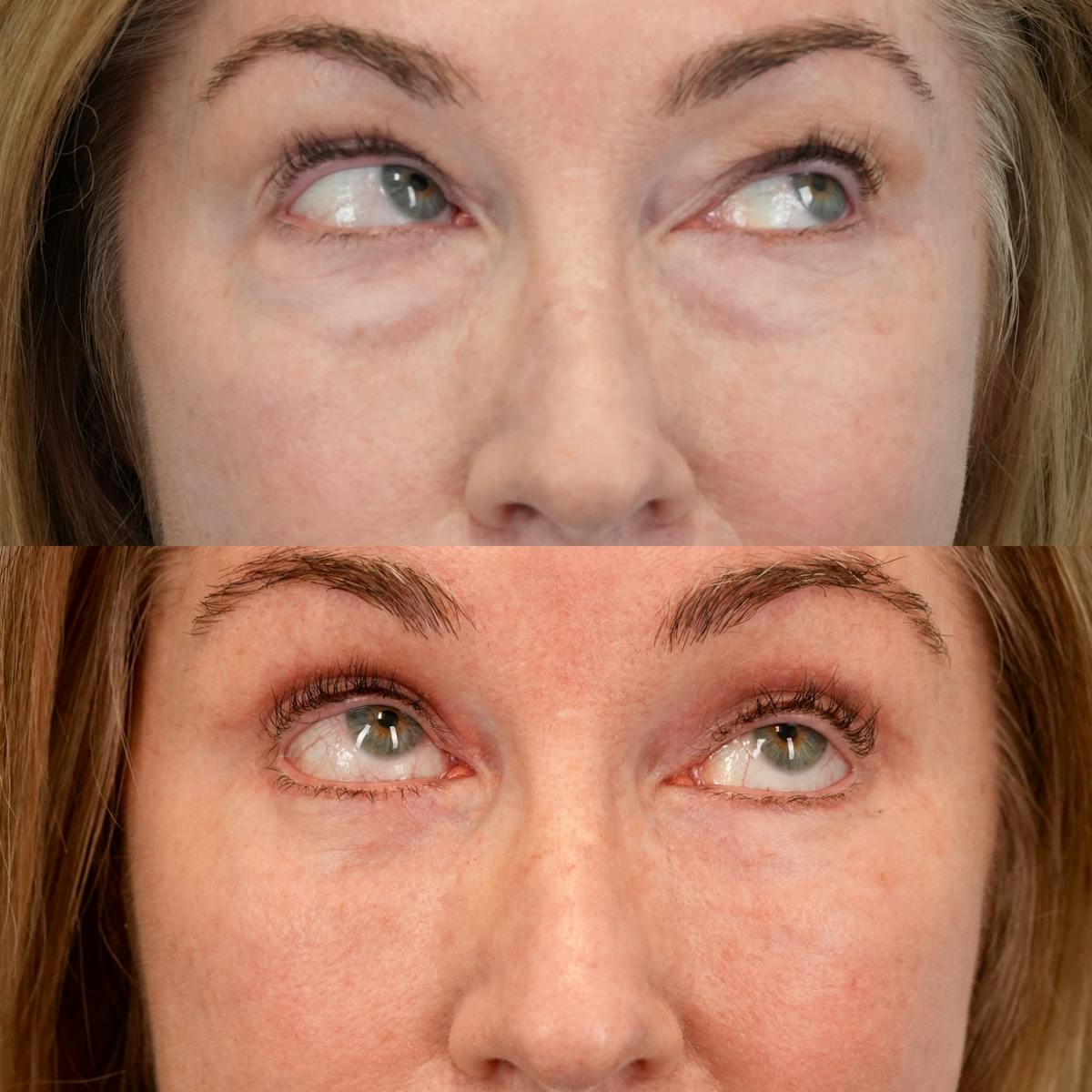 Lower Eyelids Before & After Gallery - Patient 323687 - Image 4