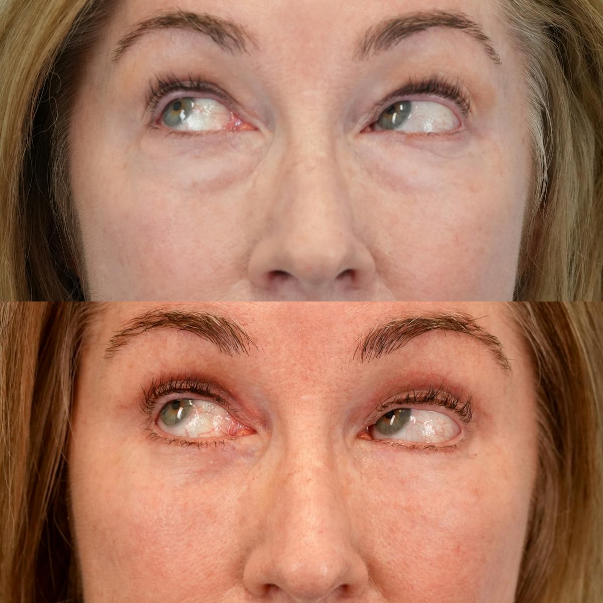 Lower Eyelids Before & After Gallery - Patient 323687 - Image 5