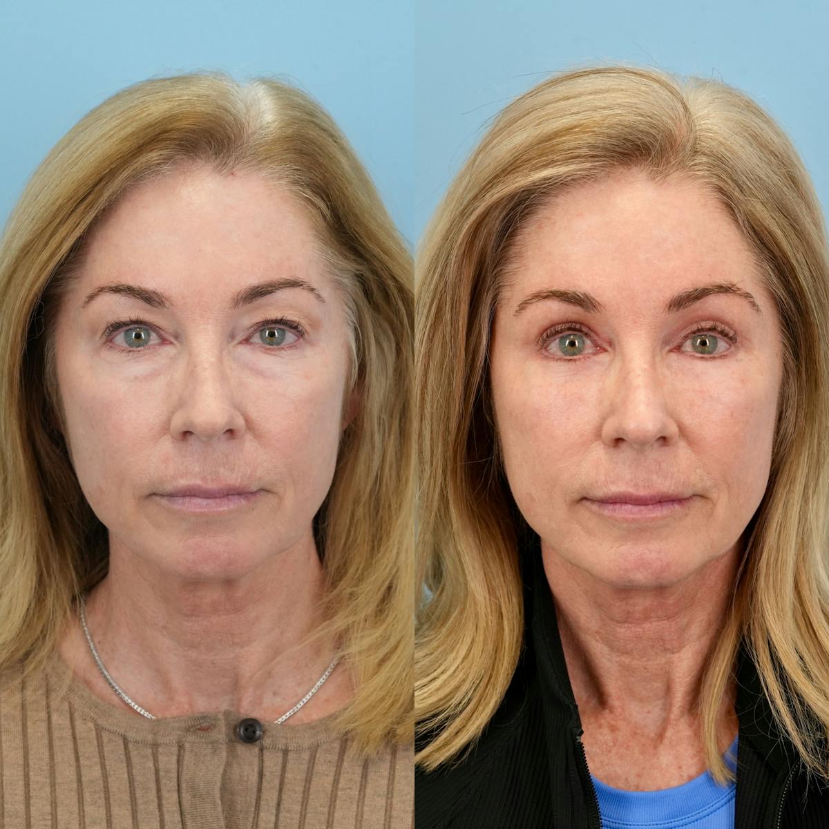 Lower Eyelids Before & After Gallery - Patient 323687 - Image 6