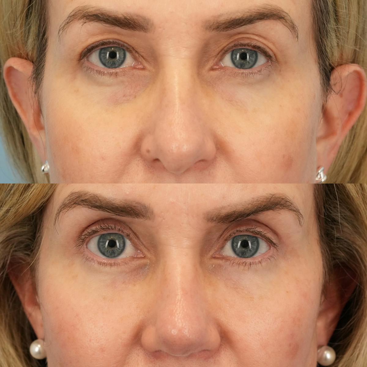 Upper Eyelids Before & After Gallery - Patient 321050 - Image 1