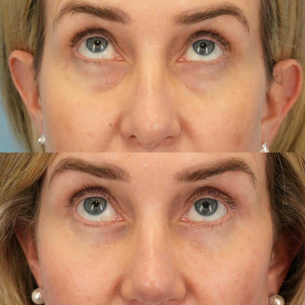 Upper Eyelids Before & After Gallery - Patient 321050 - Image 2