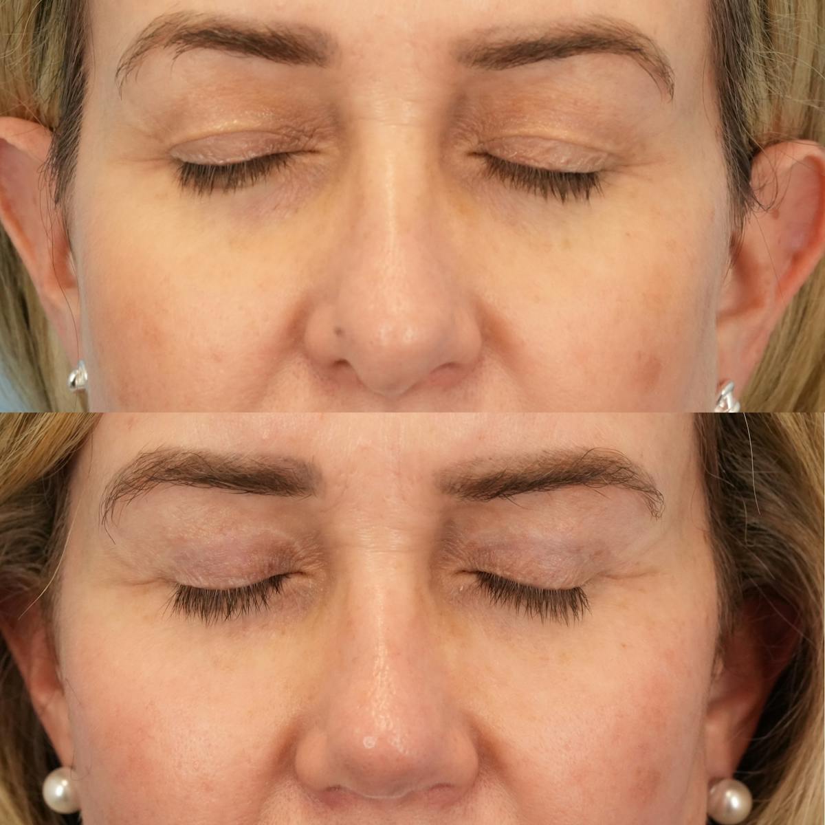 Upper Eyelids Before & After Gallery - Patient 321050 - Image 3