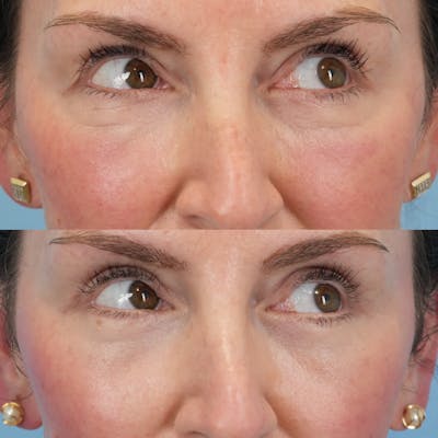 Upper Eyelids Before & After Gallery - Patient 541652 - Image 1