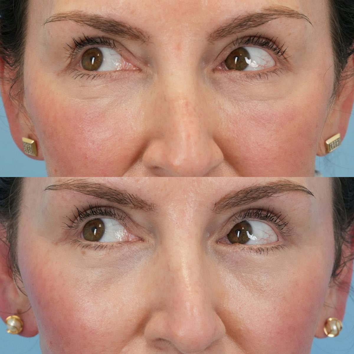 Lower Eyelids Before & After Gallery - Patient 244291 - Image 4