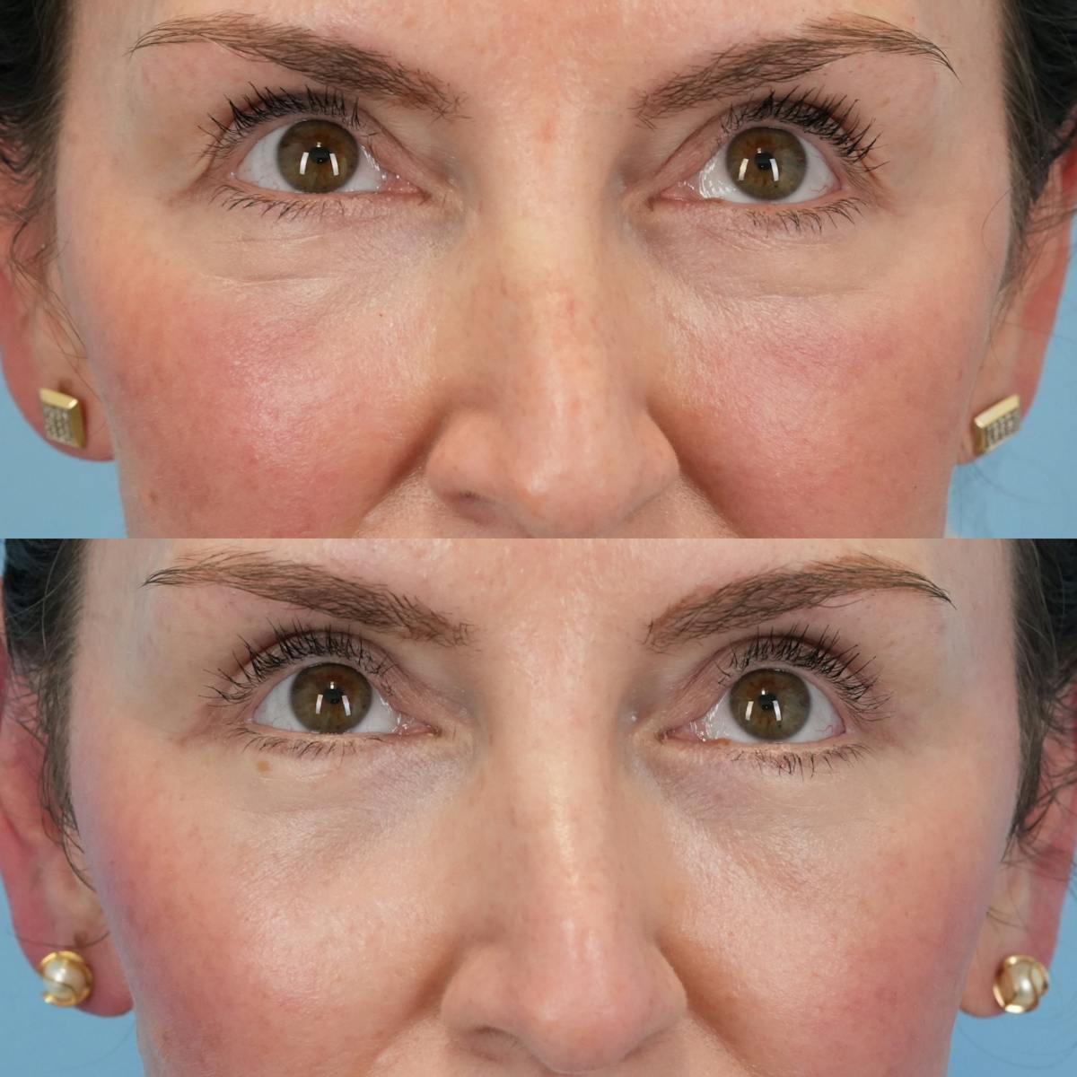 Lower Eyelids Before & After Gallery - Patient 244291 - Image 2