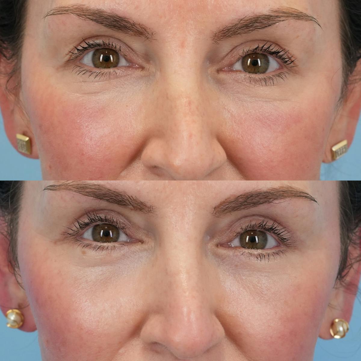Lower Eyelids Before & After Gallery - Patient 244291 - Image 1