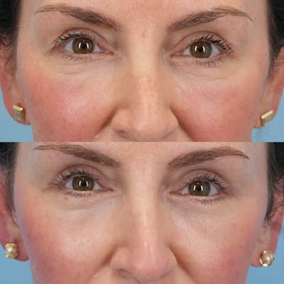 Lower Eyelids Before & After Gallery - Patient 244291 - Image 1